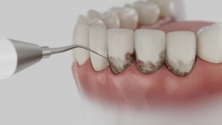 Reliable Wisdom Tooth Removal contractor in Jefferson County County, OH by Dentist Open Now
